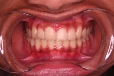 Image of patient after braces treatment | Braces Fort Worth