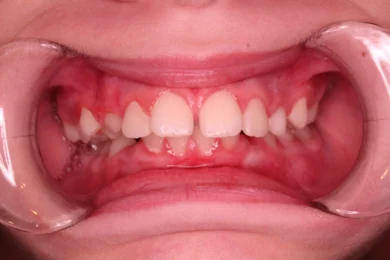 Image of patient's teeth before braces | Braces Fort Worth