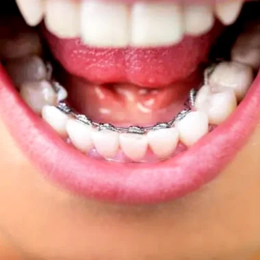 Bonded Orthodontic Retainers | Anthony Patel Orthodontics - Southlake, Fort Worth, Haslet, Texas