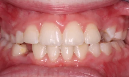 Image of teeth after braces treatment | Braces Fort Worth
