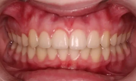 Image of patient's teeth after braces | Braces Fort Worth