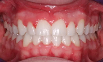 Image of teeth after braces treatment in Fort Worth | Anthony Patel Orthodontics