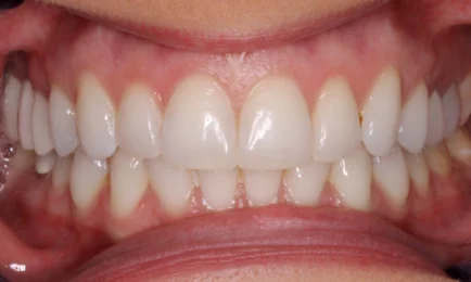 Image of patient after Invisalign treatment | Invisalign Fort Worth