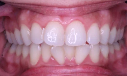 Image of teeth before braces | Braces Fort Worth