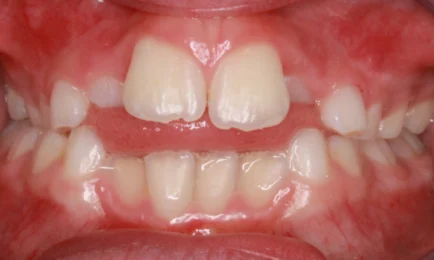 Image of teeth before braces treatment | Braces Fort Worth