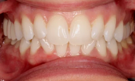 Image of patient before Invisalign treatment | Invisalign Fort Worth